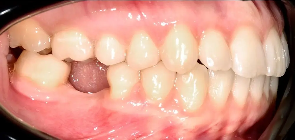 Скученность - Кейс 6 — боковой ракурс после лечения