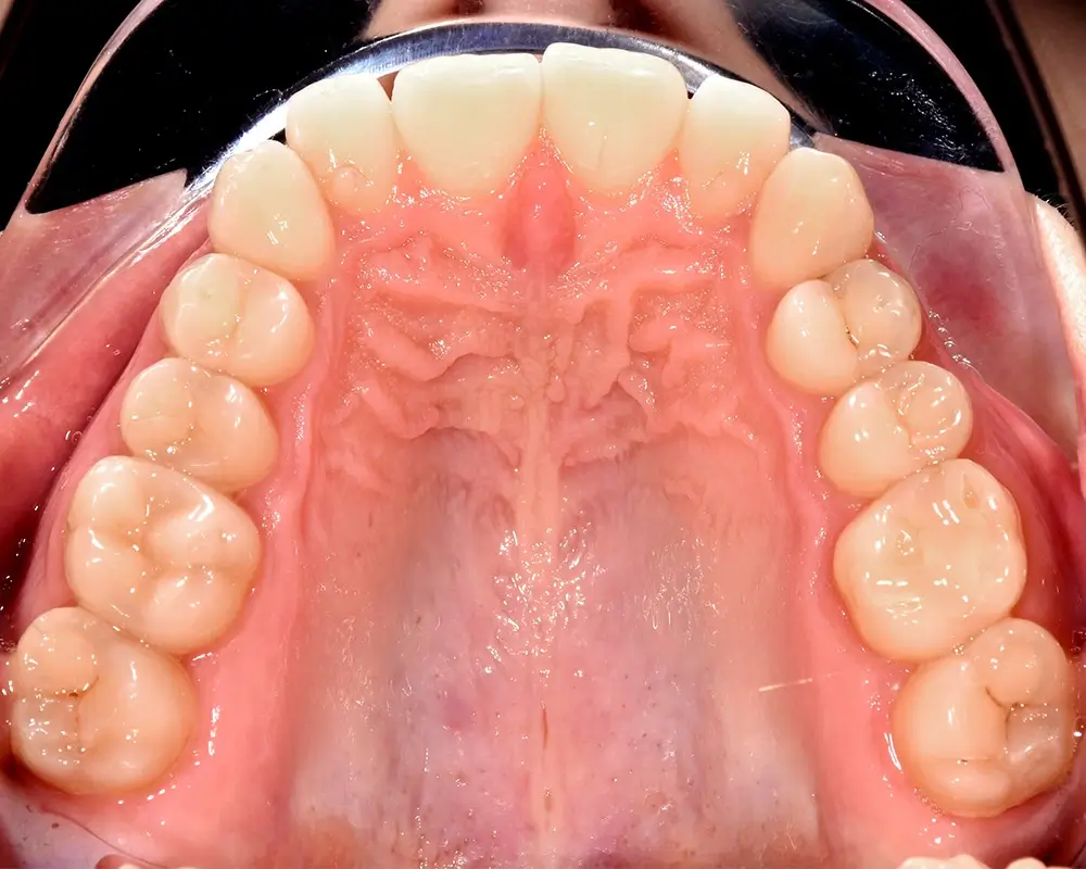 Скученность - Кейс 6 — верхняя челюсть до лечения