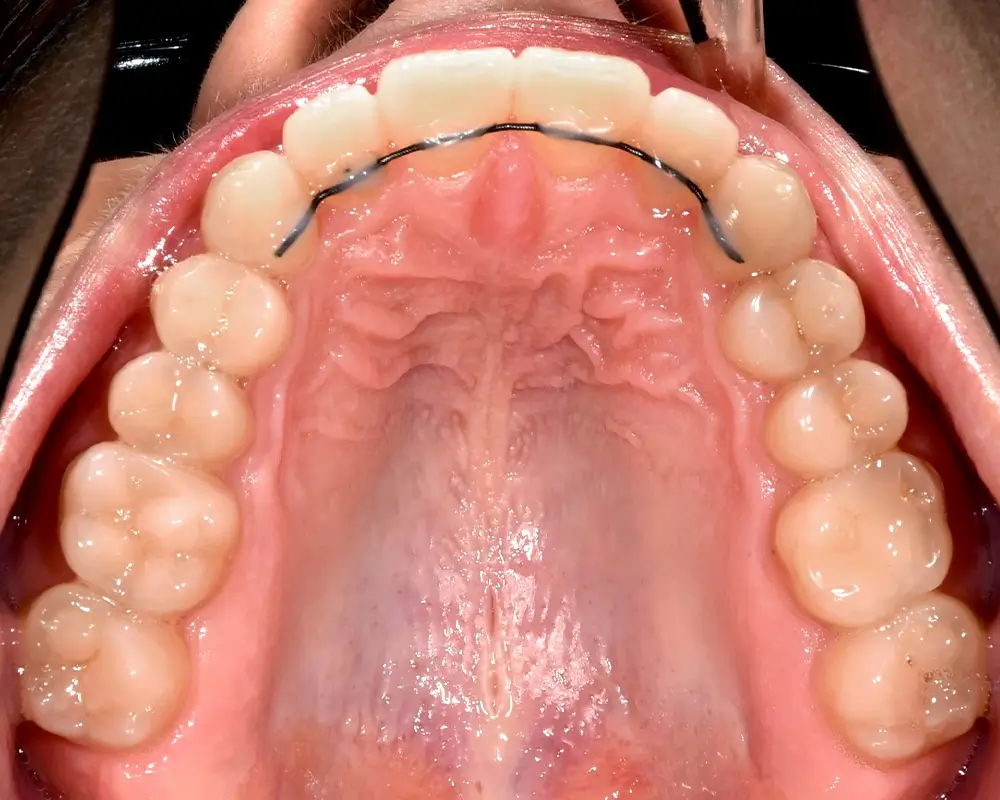 Скученность - Кейс 6 — верхняя челюсть после лечения