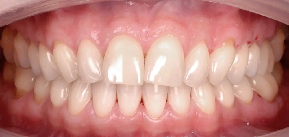 Скученность - Кейс 7 — вид спереди до лечения