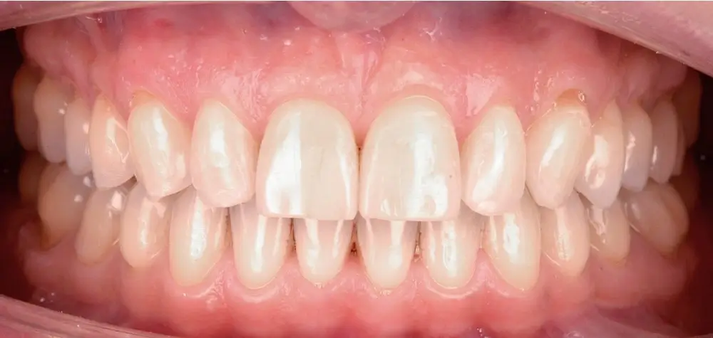 Скученность - Кейс 7 — вид спереди после лечения