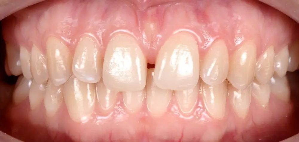 Скученность - Кейс 8 — вид спереди до лечения