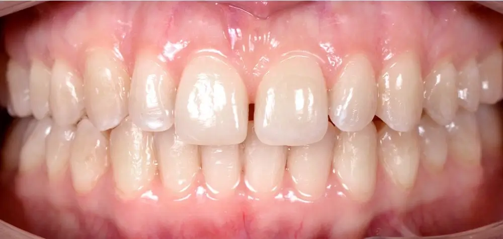 Скученность - Кейс 8 — вид спереди после лечения