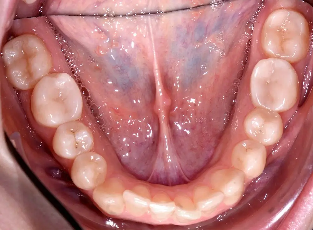 Скученность - Кейс 8 — нижняя челюсть до лечения