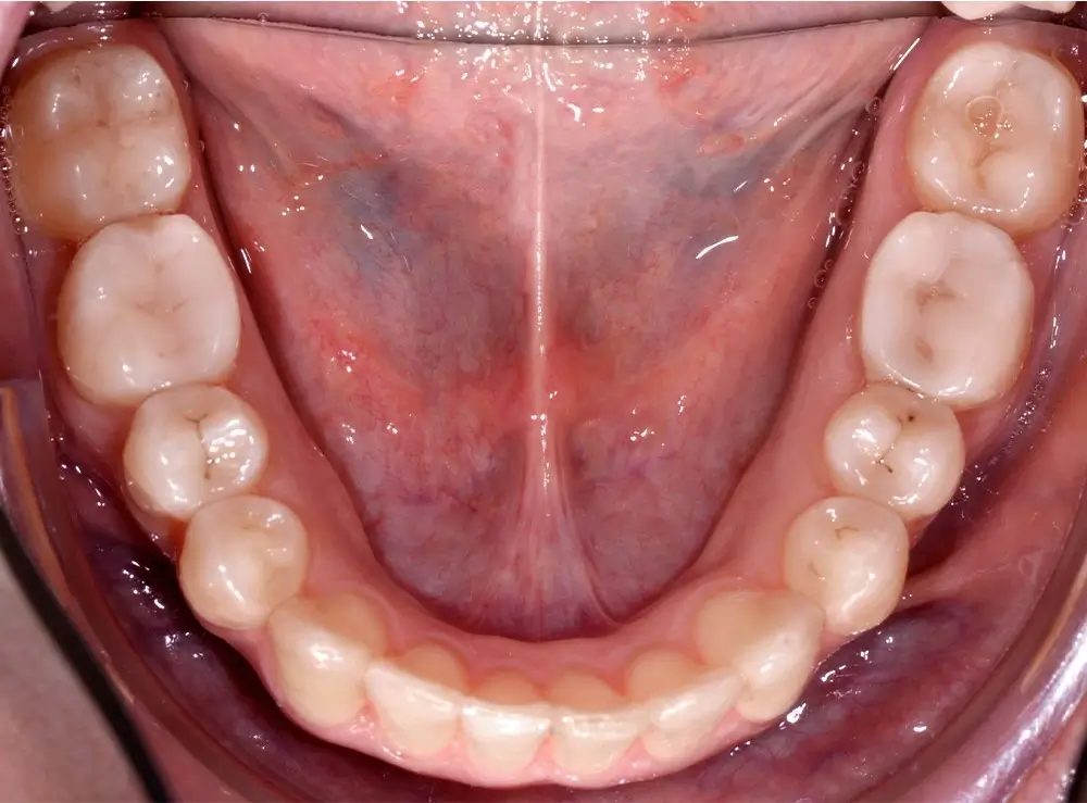 Скученность - Кейс 8 — нижняя челюсть после лечения