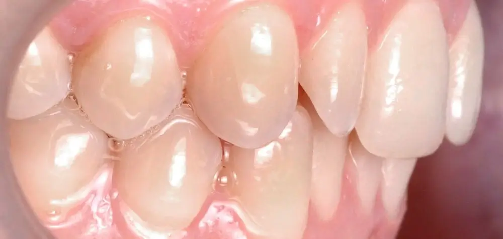 Скученность - Кейс 8 — боковой ракурс до лечения