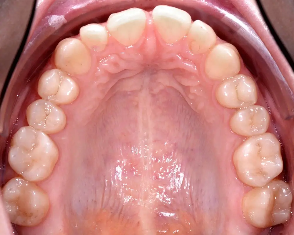 Скученность - Кейс 8 — верхняя челюсть до лечения