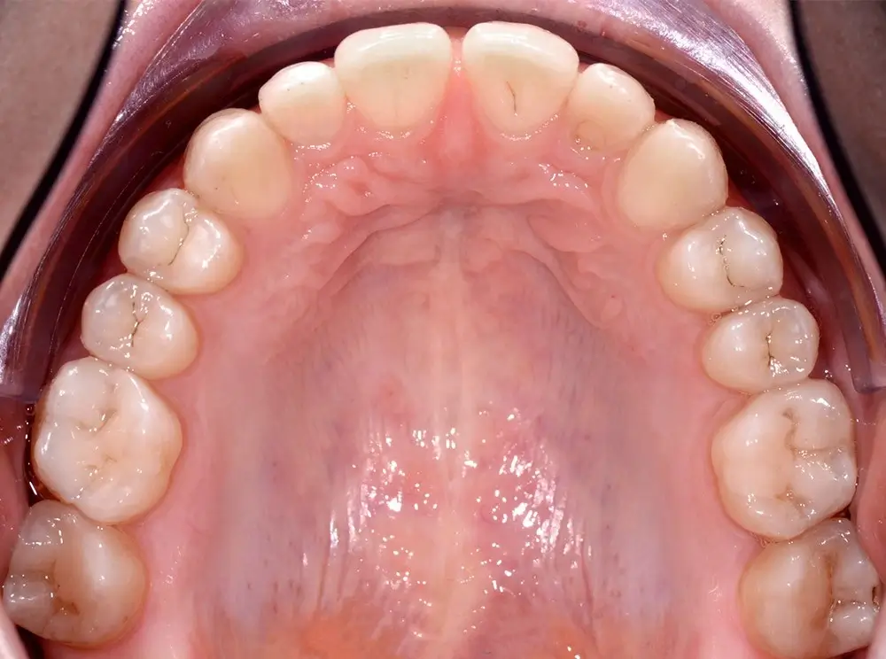 Скученность - Кейс 8 — верхняя челюсть после лечения