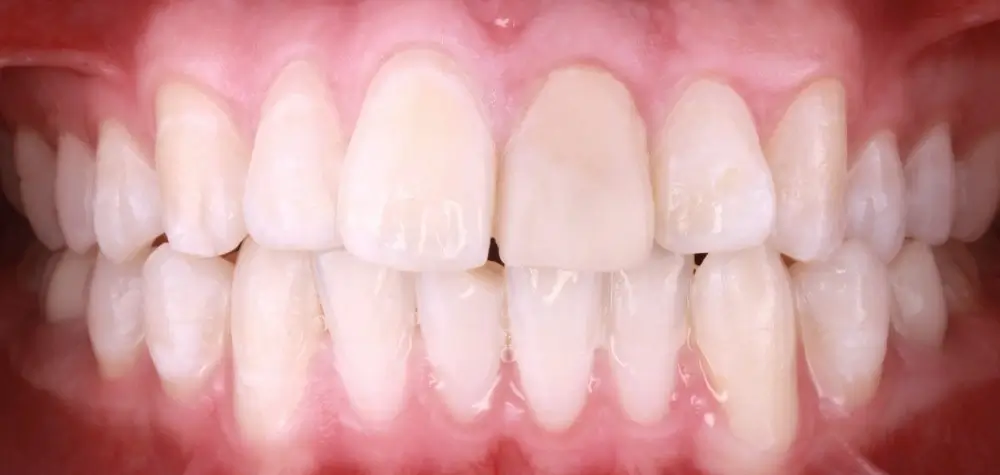 Скученность - Кейс 9 — фронтальный ракурс до лечения