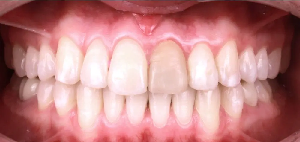 Скученность - Кейс 9 — фронтальный ракурс после лечения