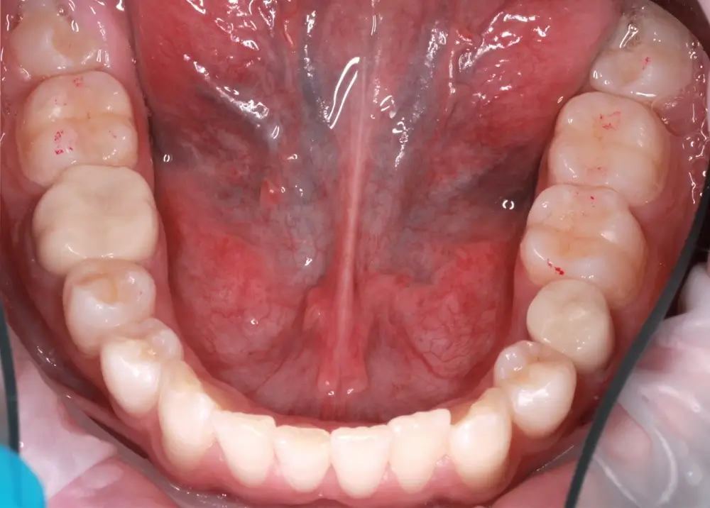 Скученность - Кейс 9 — нижняя челюсть до лечения