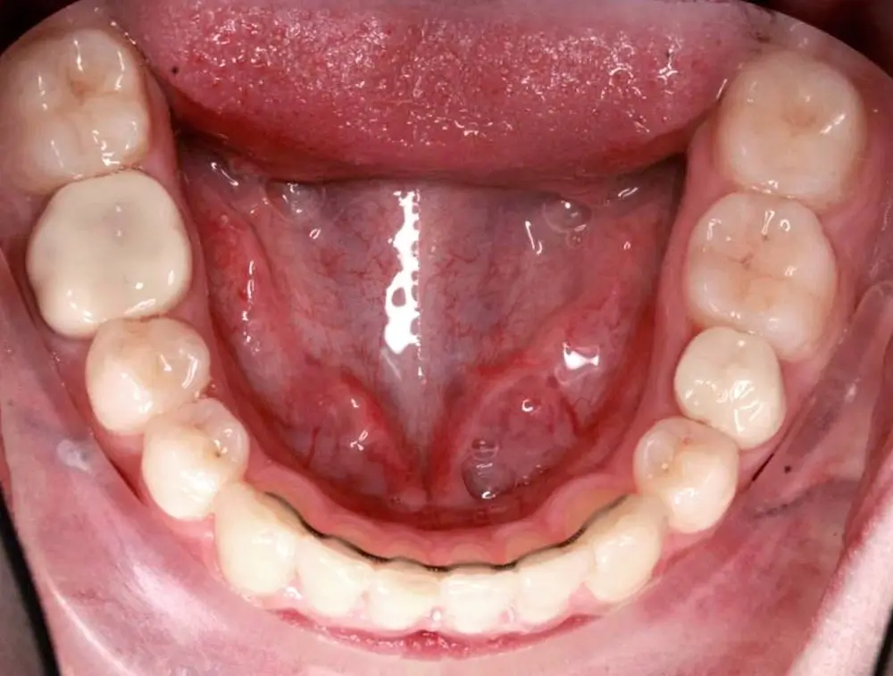 Скученность - Кейс 9 — нижняя челюсть после лечения