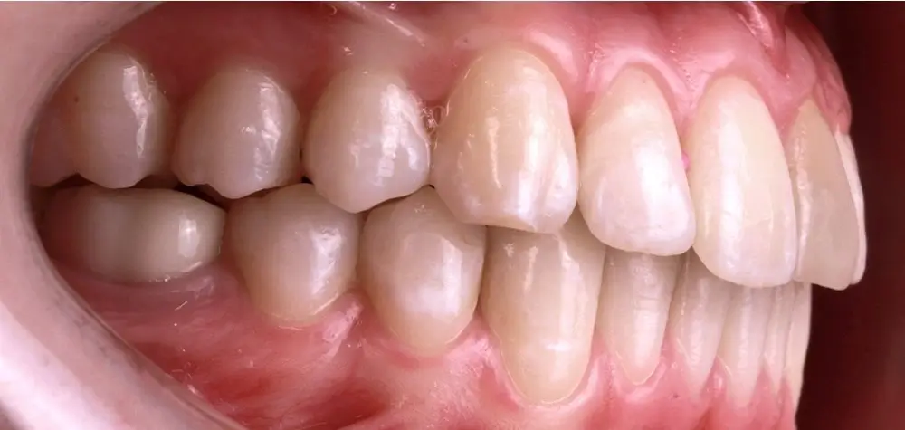 Скученность - Кейс 9 — боковой ракурс после лечения