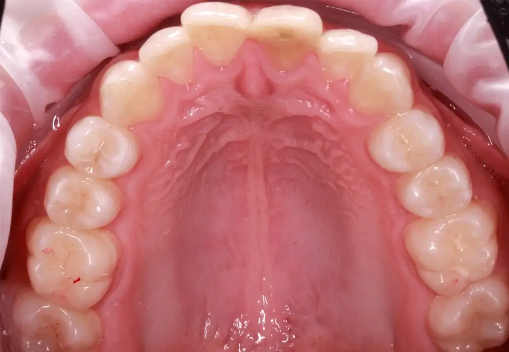 Скученность - Кейс 9 — верхняя челюсть до лечения