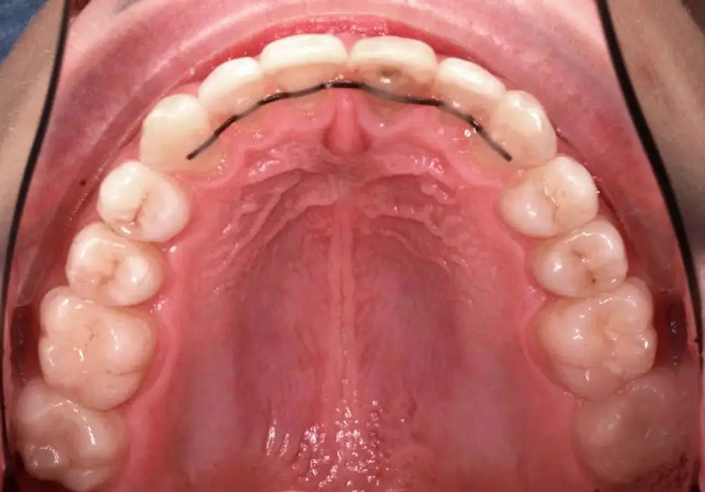 Скученность - Кейс 9 — верхняя челюсть после лечения