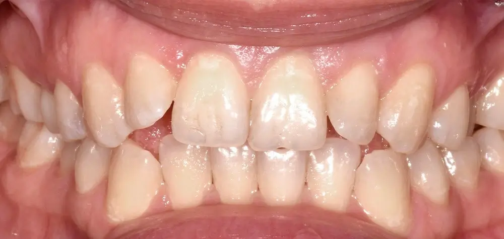 Открытый прикус - Кейс 1 — вид спереди до лечения