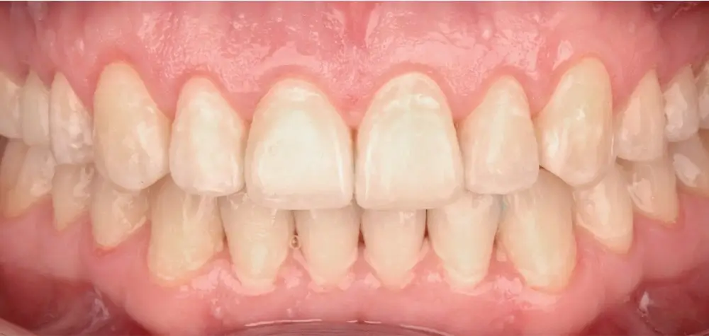 Открытый прикус - Кейс 1 — вид спереди после лечения