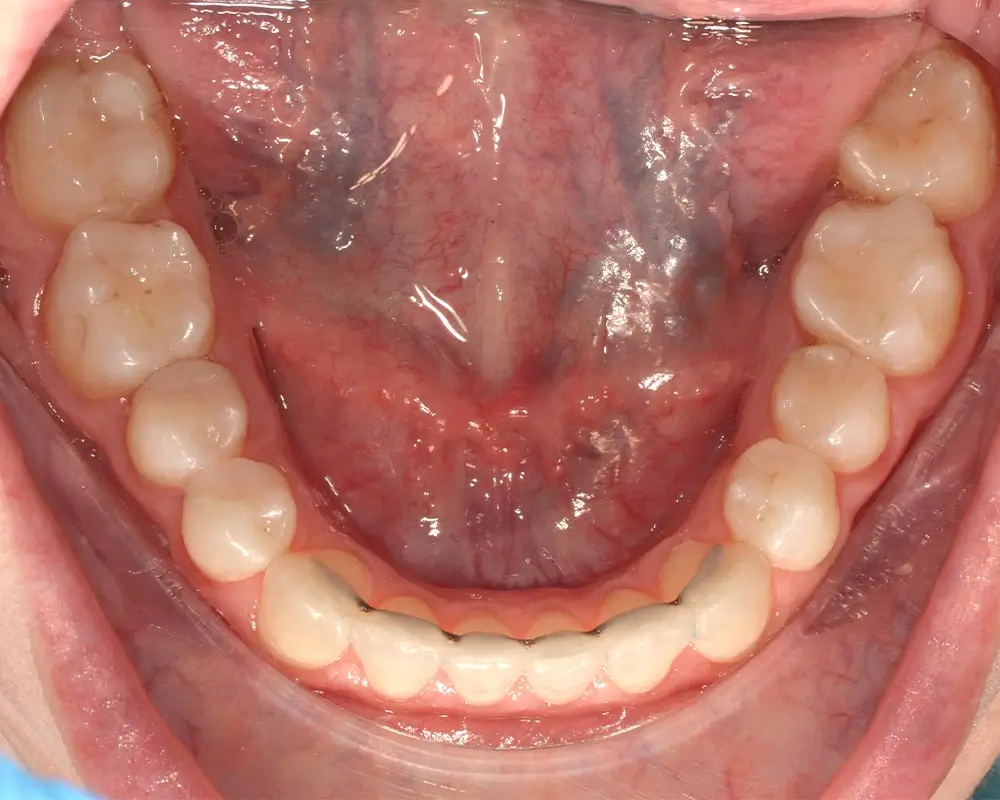 Открытый прикус - Кейс 1 — нижняя челюсть после лечения