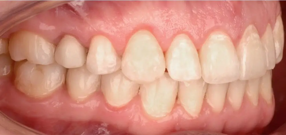 Открытый прикус - Кейс 1 — боковой ракурс после лечения