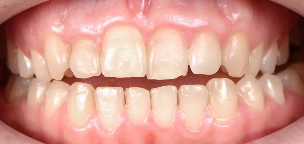 Открытый прикус - Кейс 2 — вид спереди до лечения