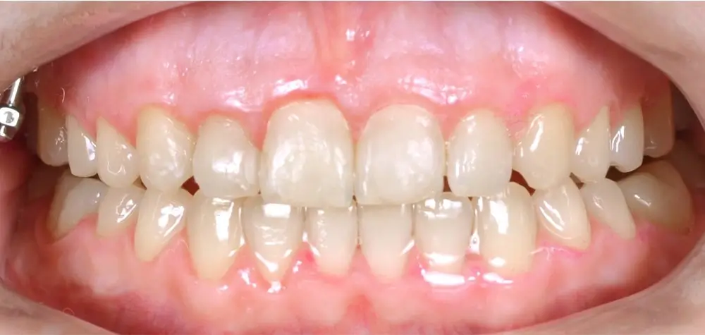 Открытый прикус - Кейс 2 — вид спереди после лечения