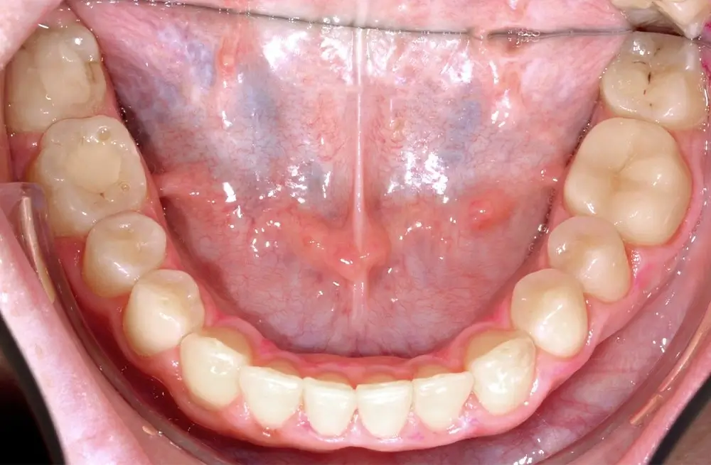 Открытый прикус - Кейс 2 — нижняя челюсть после лечения