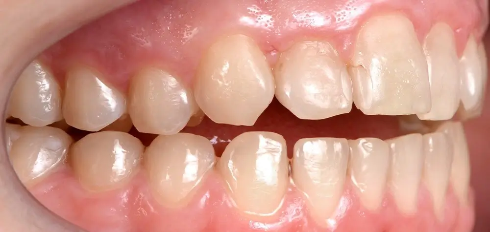 Открытый прикус - Кейс 2 — боковой ракурс до лечения