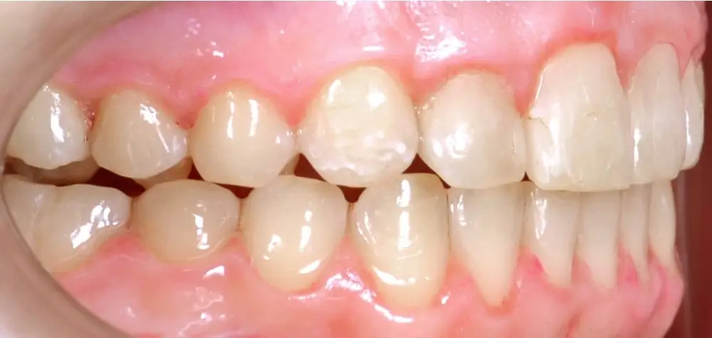 Открытый прикус - Кейс 2 — боковой ракурс после лечения