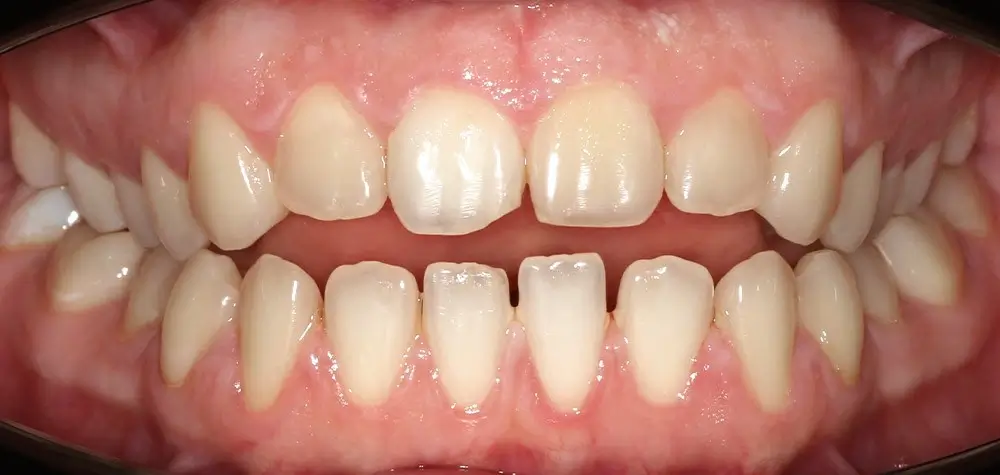 Открытый прикус - Кейс 4 — вид спереди до лечения