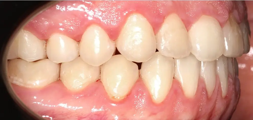 Открытый прикус - Кейс 4 — боковой ракурс после лечения