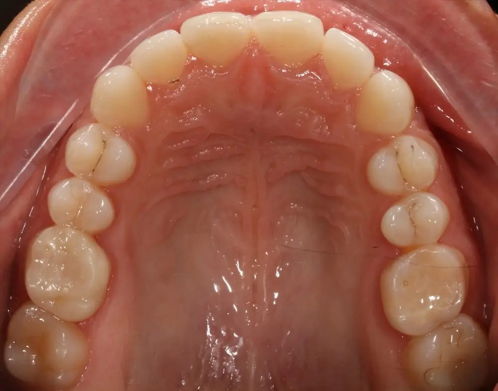 Открытый прикус - Кейс 4 — верхняя челюсть до лечения