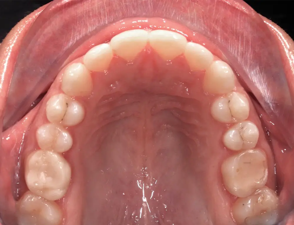 Открытый прикус - Кейс 4 — верхняя челюсть после лечения