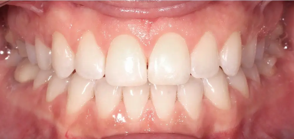 О ткрытый прикус - Кейс 5 — фронтальный ракурс после лечения