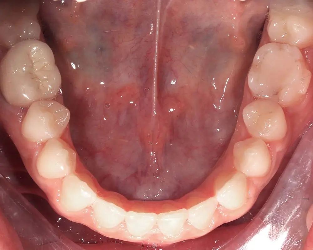 Открытый прикус - Кейс 5 — нижняя челюсть после лечения