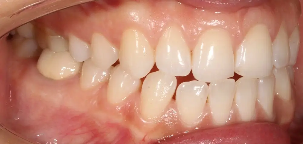 Открытый прикус - Кейс 5 — боковой ракурс до лечения