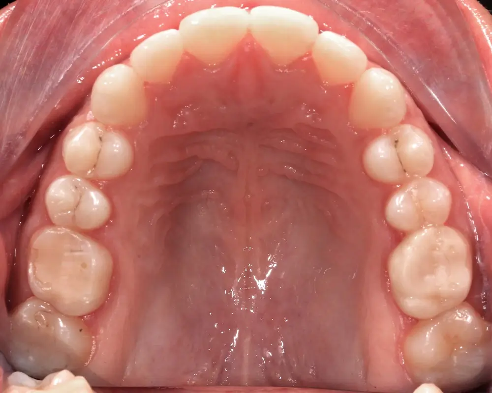 Открытый прикус - Кейс 5 — верхняя челюсть до лечения