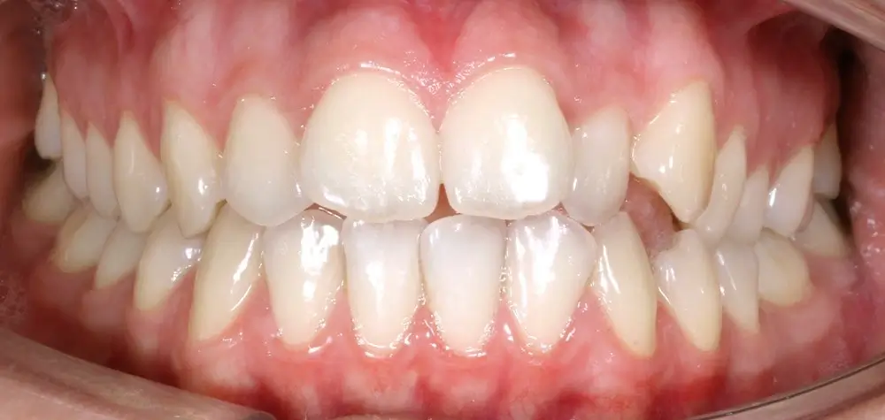 Открытый прикус - Кейс 6 — вид спереди до лечения