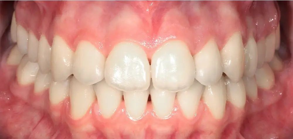 Открытый прикус - Кейс 6 — вид спереди после лечения