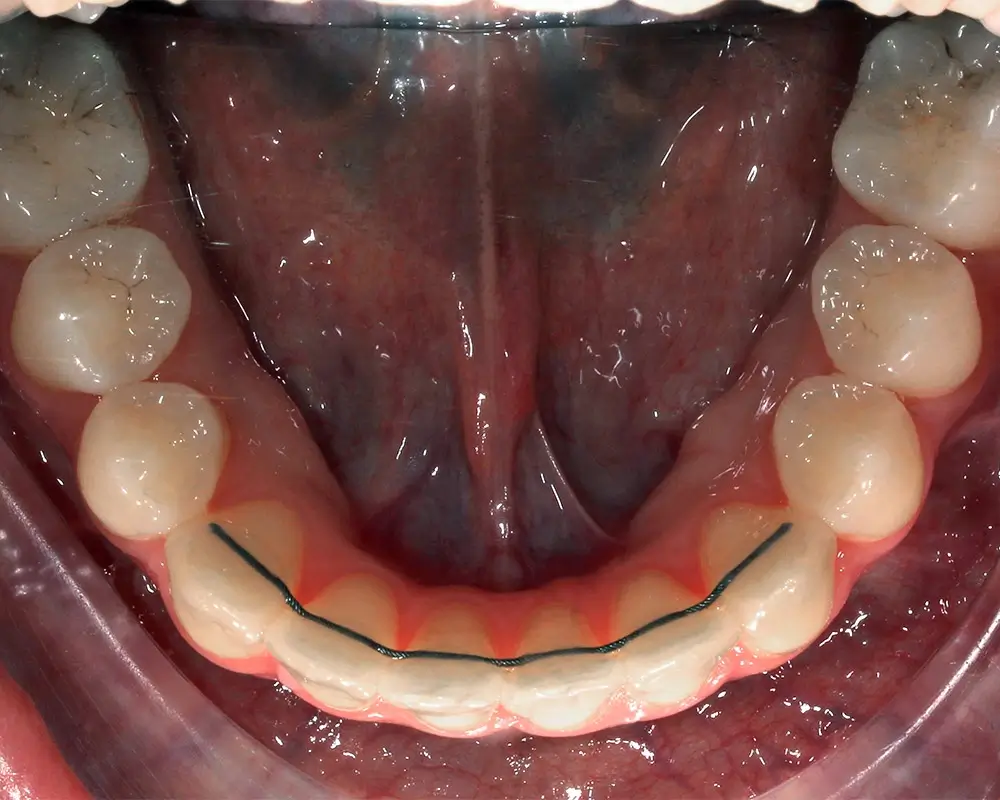 Открытый прикус - Кейс 6 — нижняя челюсть после лечения