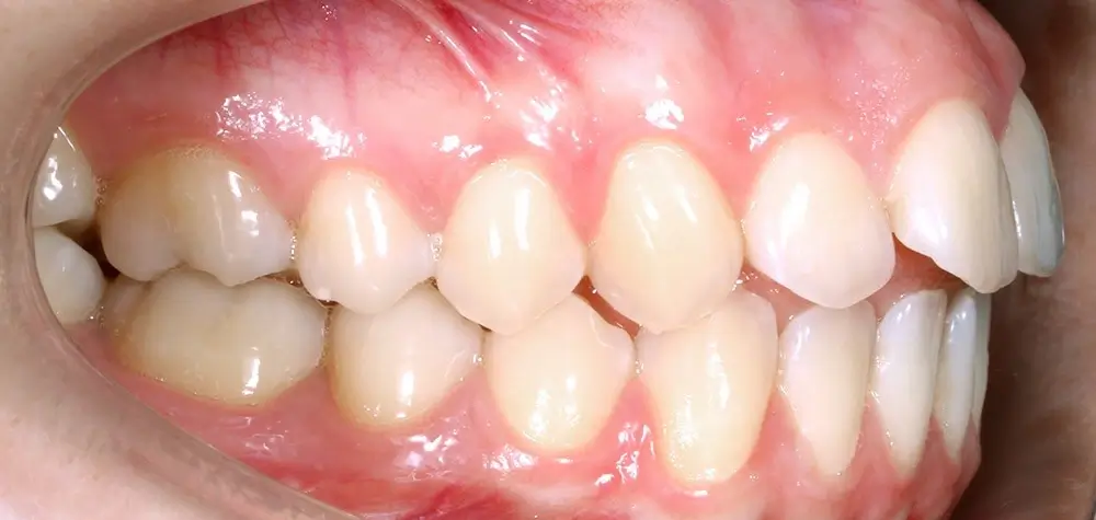 Открытый прикус - Кейс 6 — боковой ракурс до лечения