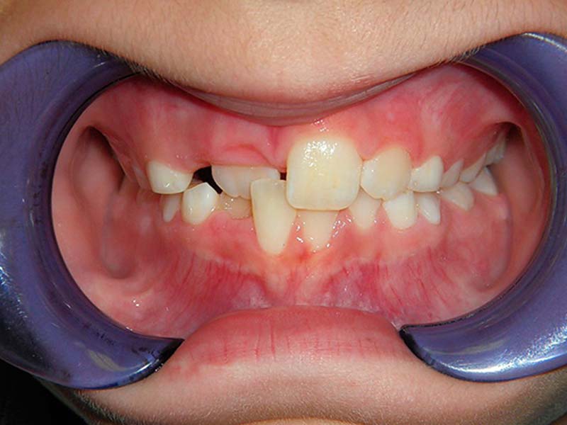Стоматологические проблемы, приводящие к нарушению речи