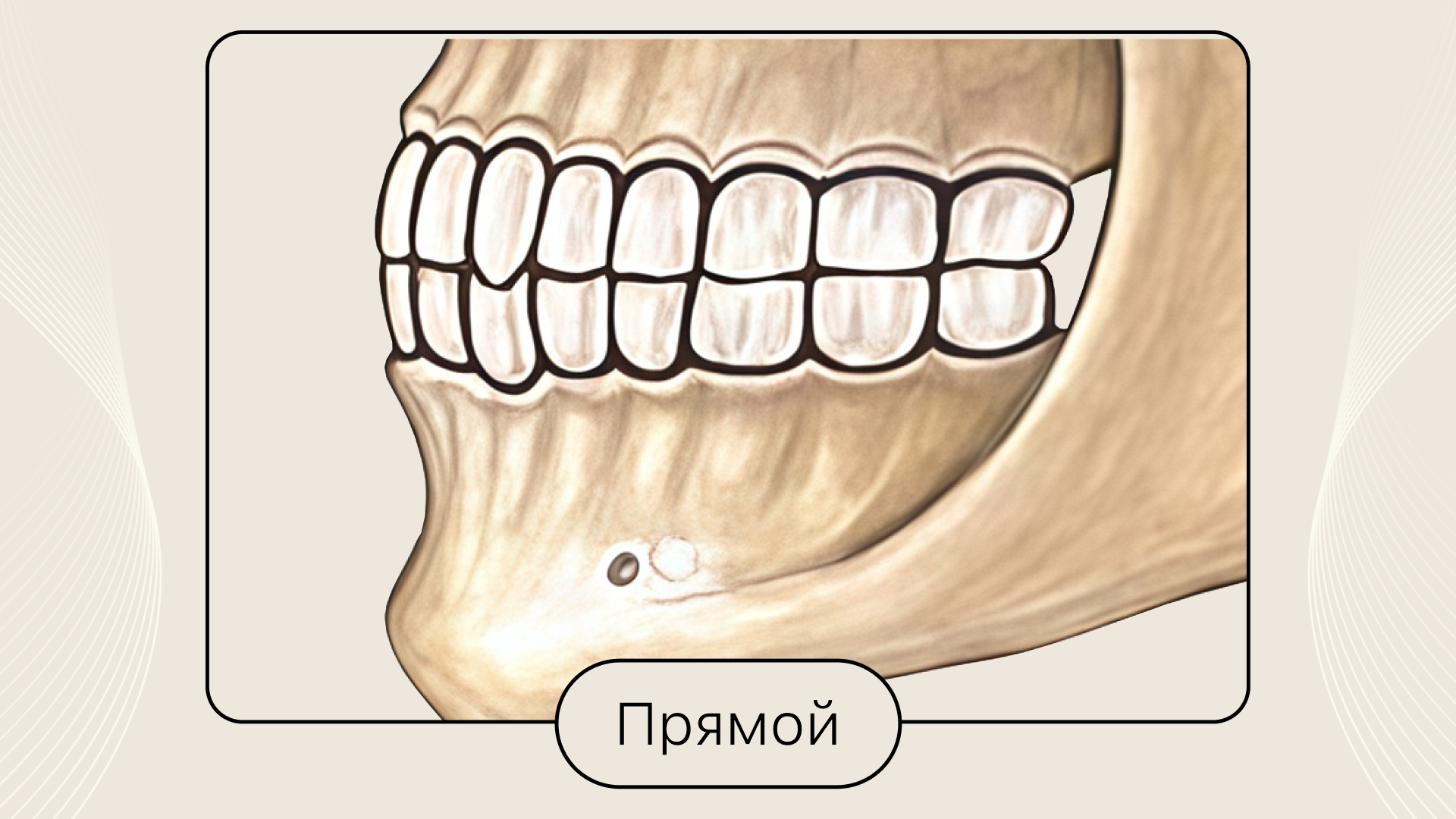 Прямой прикус