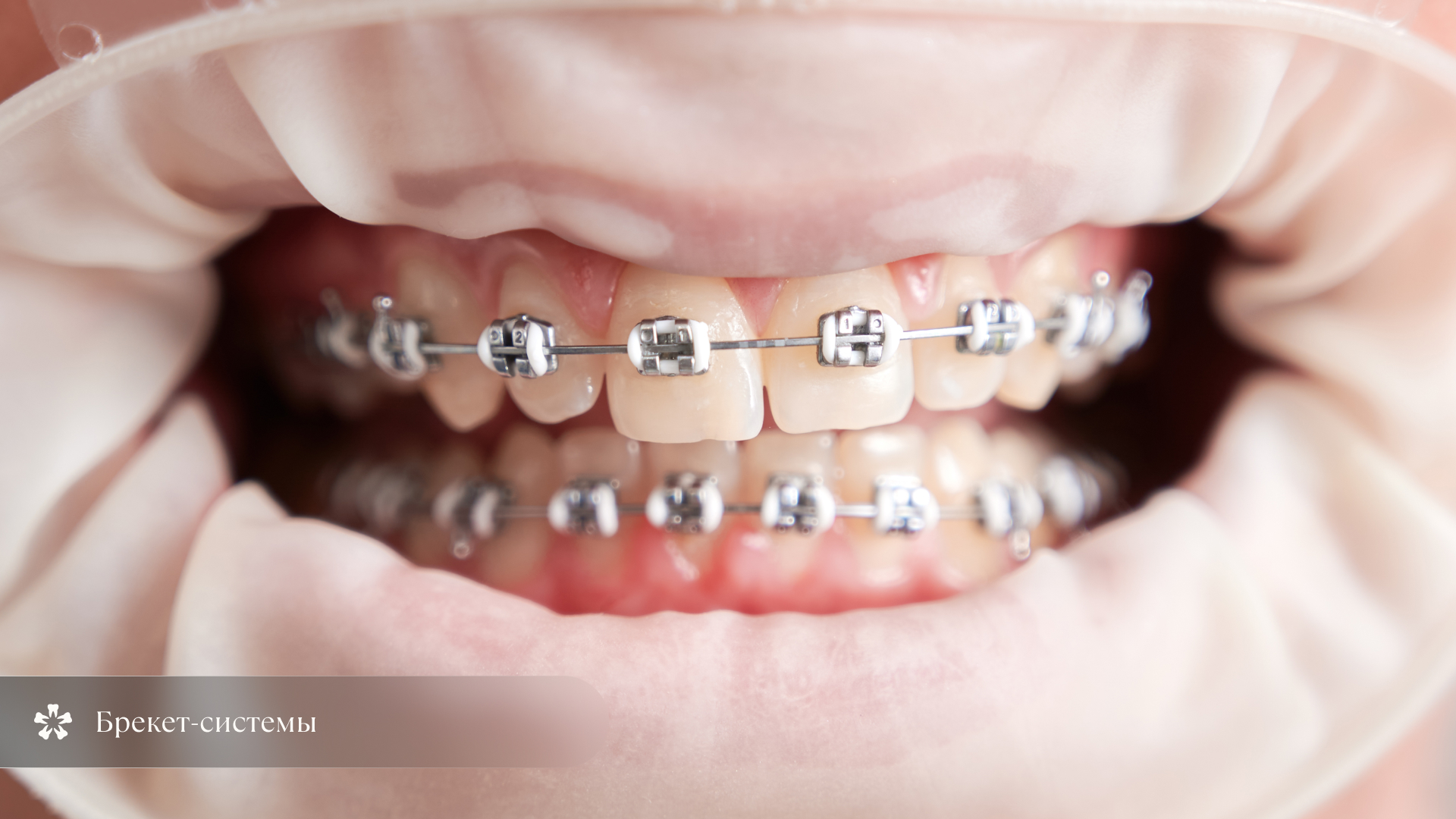 Брекет-системы