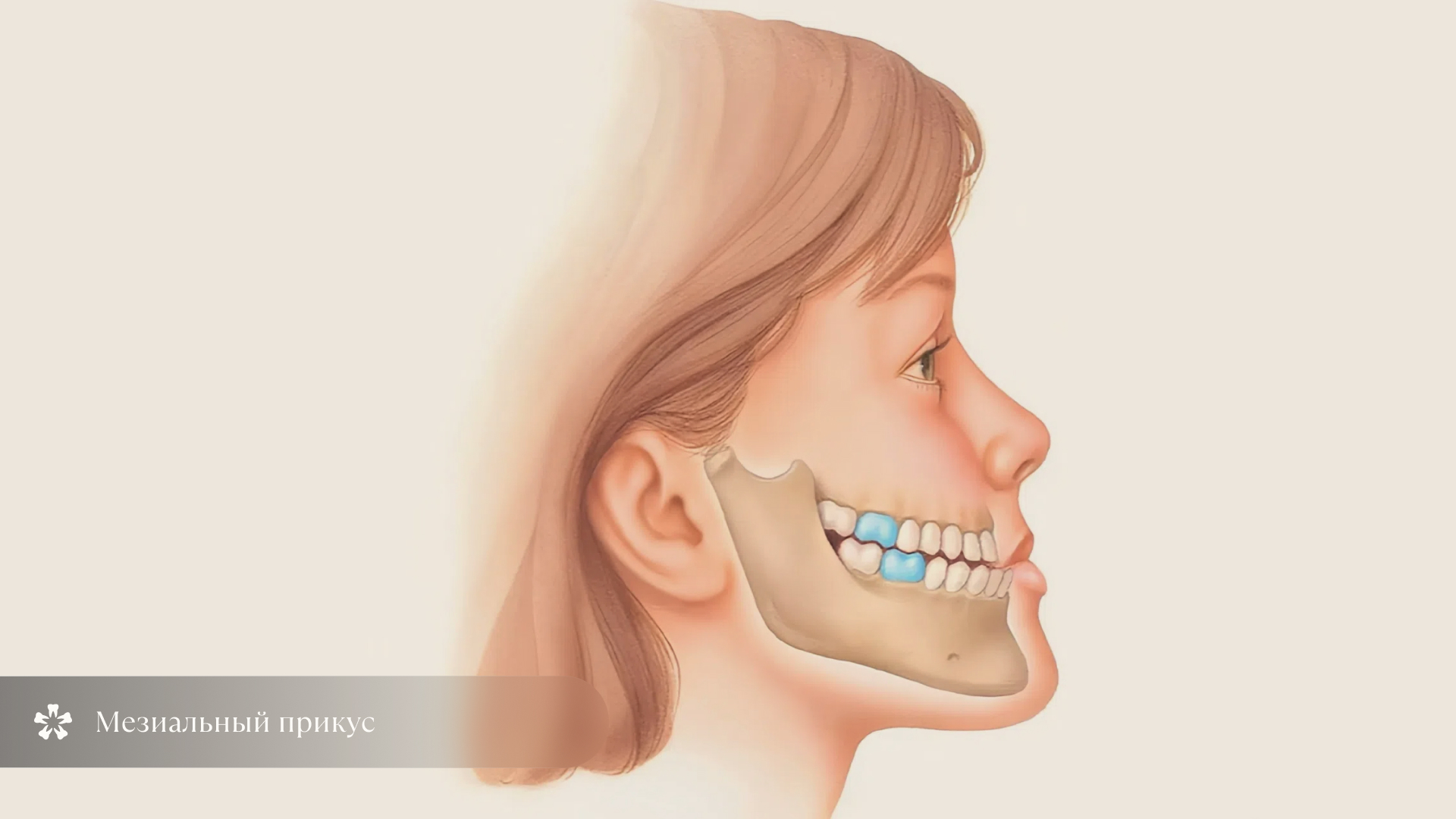 Мезиальный прикус
