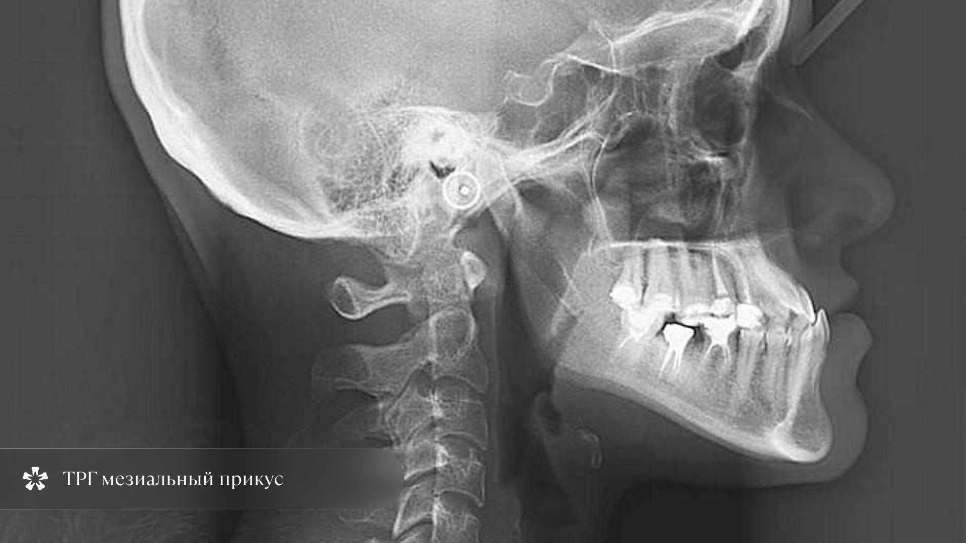 Диагностика мезиального прикуса у детей