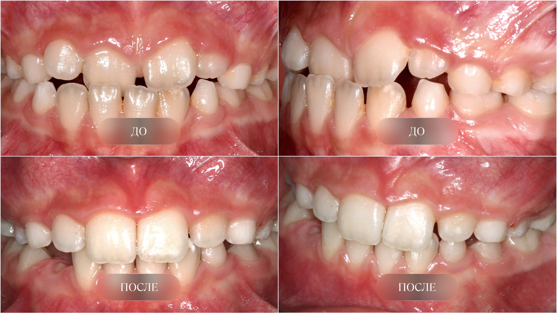 Мезиальный прикус до и после
