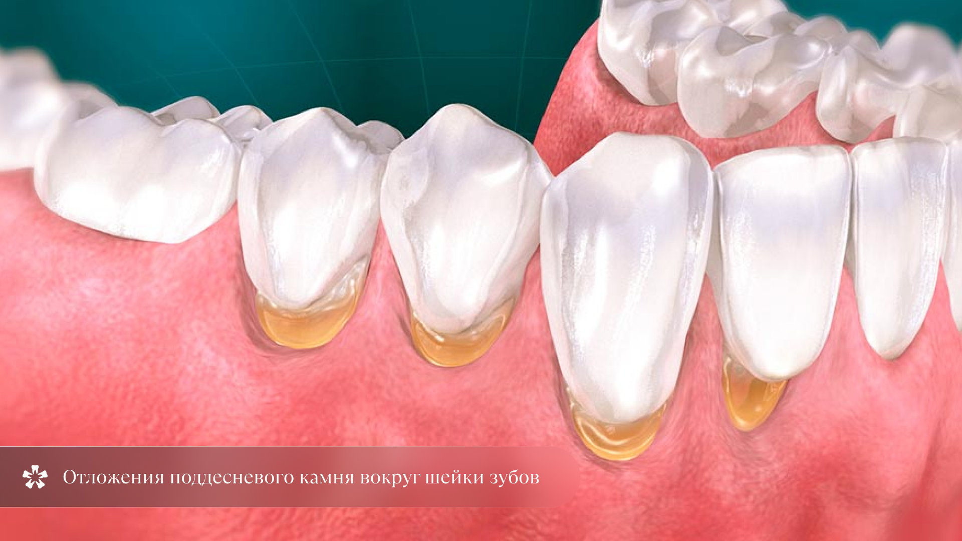 Отложения поддесневого зубного камня вокруг шейки зубов — последствия неправильного прикуса и плохой гигиены полости рта