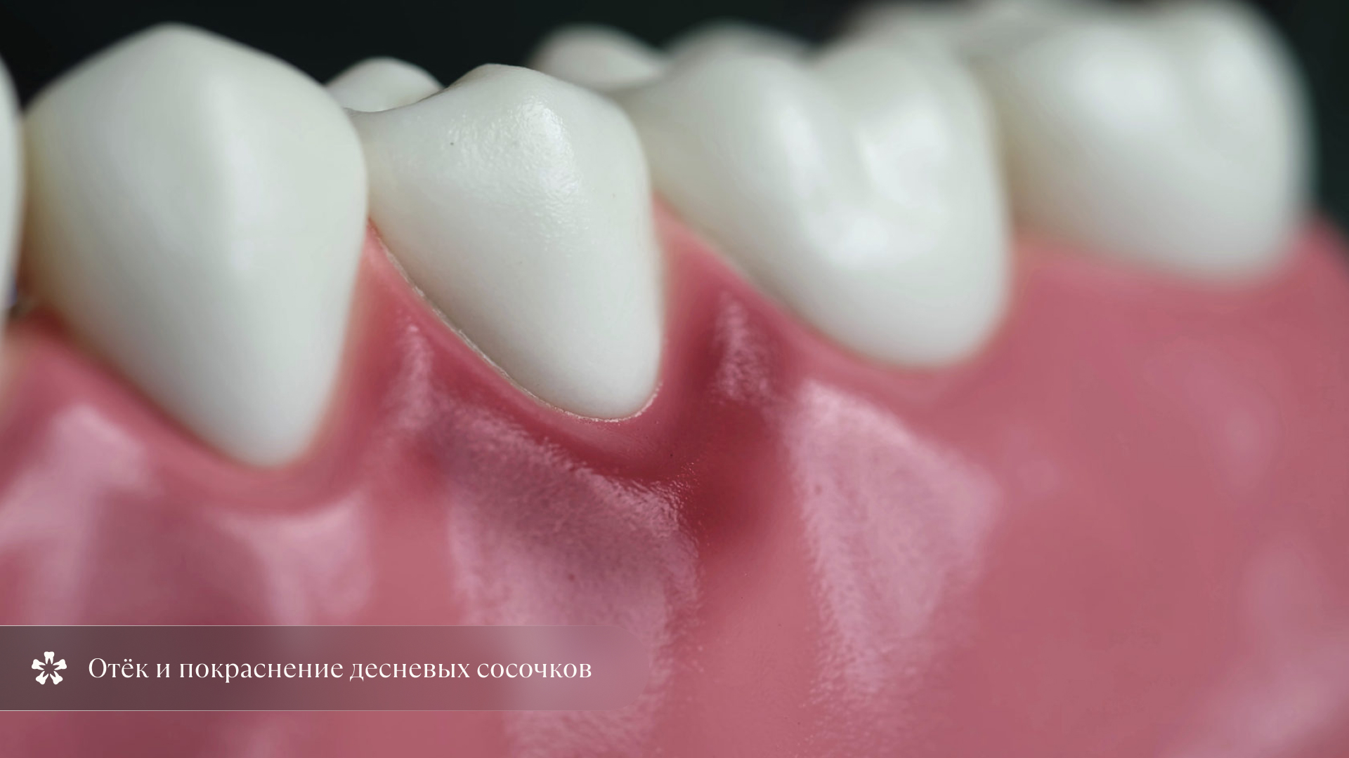 Отёк и покраснение дёсен при открытом прикусе у ребёнка