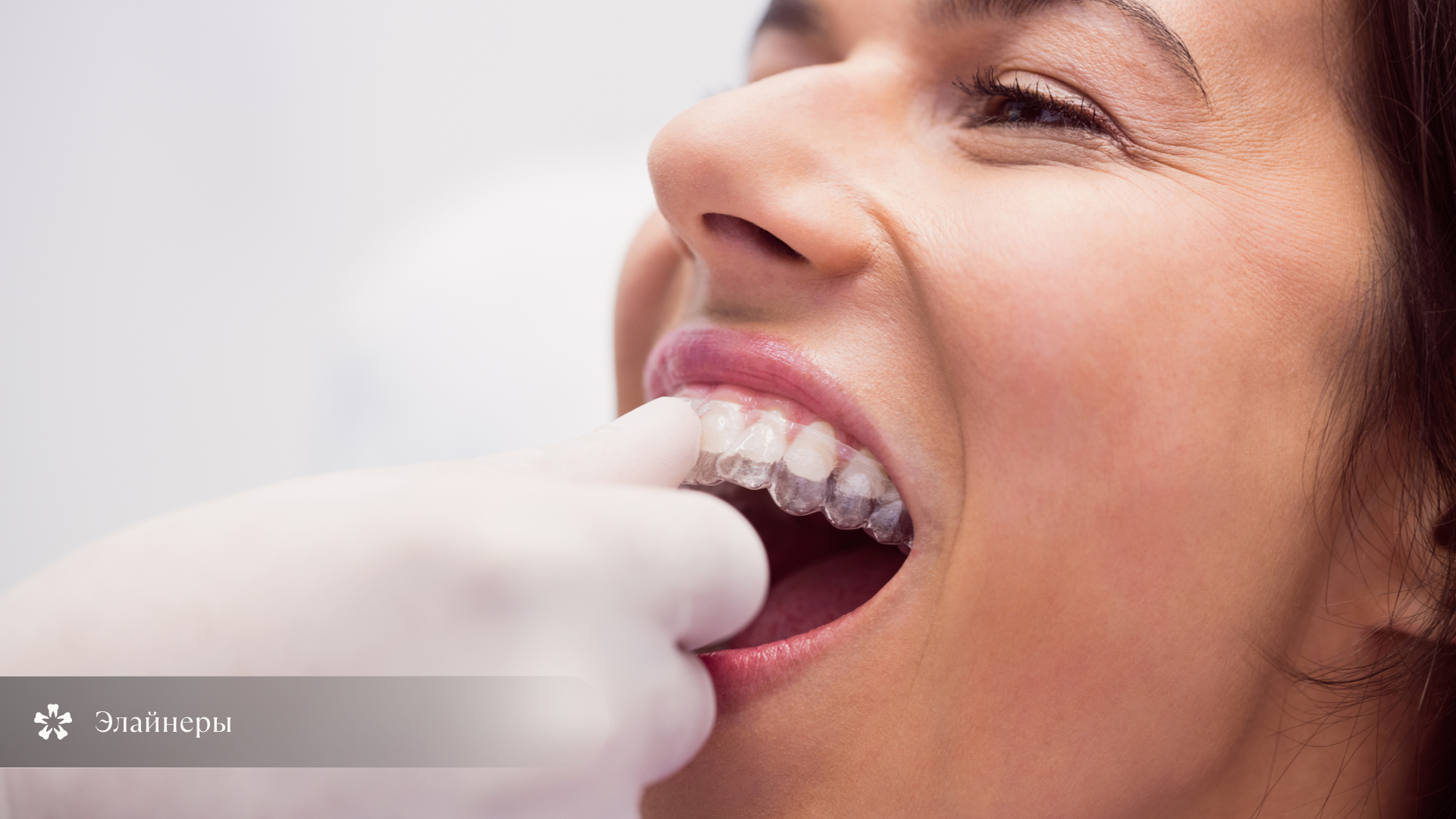 Элайнеры для выравнивания зубов и коррекции открытого прикуса у детей и взрослых