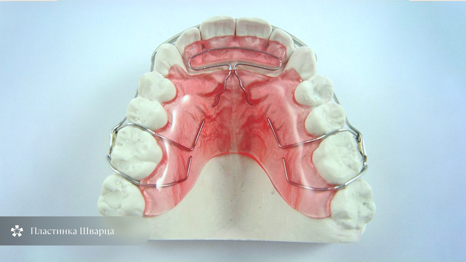 Ортодонтическая пластинка Шварца для коррекции открытого прикуса у ребёнка